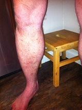 psoriasis after